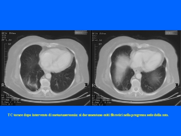 TC torace dopo intervento di metastasectomia: si documentano esiti fibrotici nella pregressa sede della