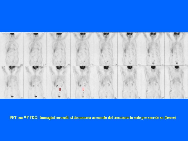  PET con 18 F FDG: Immagini coronali: si documenta accumulo del tracciante in