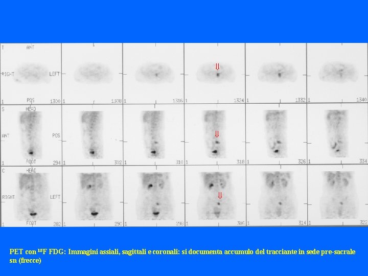  PET con 18 F FDG: Immagini assiali, sagittali e coronali: si documenta accumulo