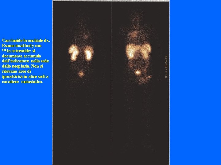 Carcinoide bronchiale dx. Esame total body con 111 In octreotide: si documenta accumulo dell’indicatore