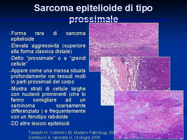Sarcoma epitelioide di tipo prossimale -Forma rara di sarcoma epitelioide -Elevata aggressività (superiore alla Sarcoma epitelioide di tipo prossimale -Forma rara di sarcoma epitelioide -Elevata aggressività (superiore alla