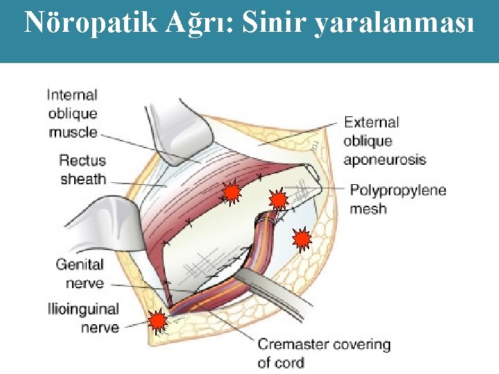 Nöropatik Ağrı: Sinir yaralanması 