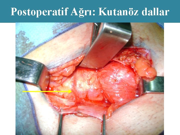 Postoperatif Ağrı: Kutanöz dallar 