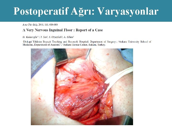 Postoperatif Ağrı: Varyasyonlar 