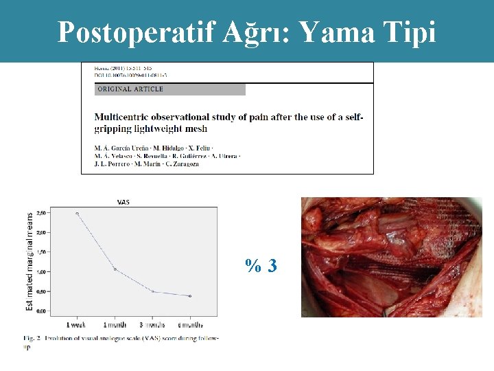 Postoperatif Ağrı: Yama Tipi %3 