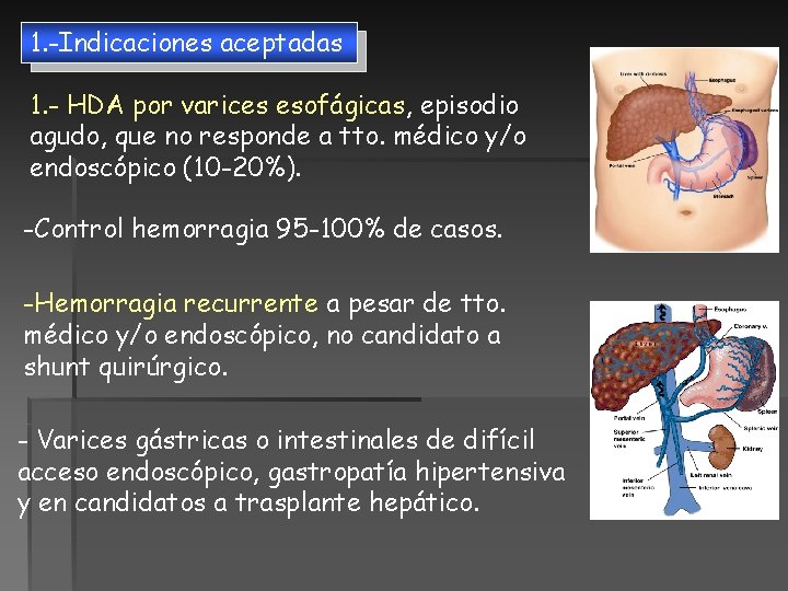 1. -Indicaciones aceptadas 1. - HDA por varices esofágicas, episodio agudo, que no responde 1. -Indicaciones aceptadas 1. - HDA por varices esofágicas, episodio agudo, que no responde