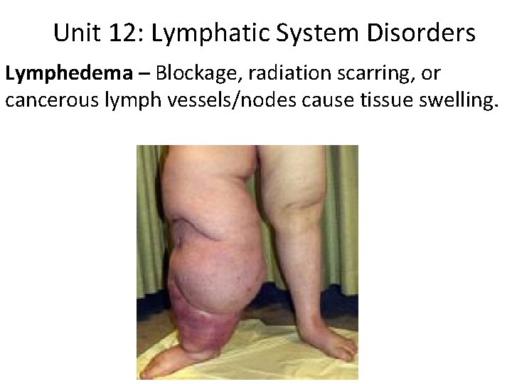 Unit 12: Lymphatic System Disorders Lymphedema – Blockage, radiation scarring, or cancerous lymph vessels/nodes