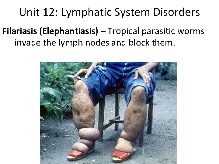 Unit 12: Lymphatic System Disorders Filariasis (Elephantiasis) – Tropical parasitic worms invade the lymph