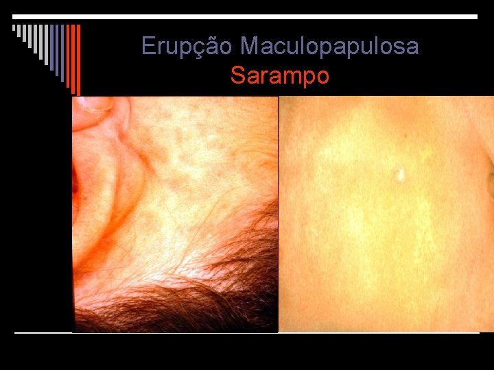 Erupção Maculopapulosa Sarampo 