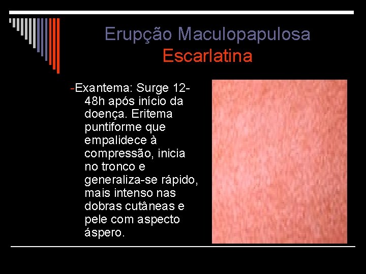 Erupção Maculopapulosa Escarlatina -Exantema: Surge 1248 h após início da doença. Eritema puntiforme que