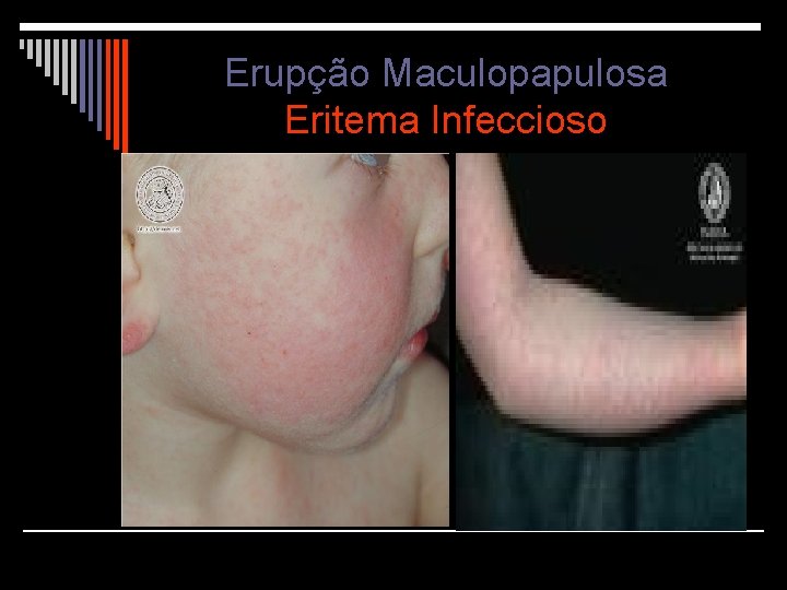 Erupção Maculopapulosa Eritema Infeccioso 