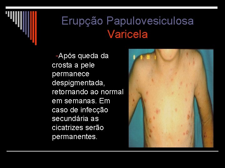 Erupção Papulovesiculosa Varicela -Após queda da crosta a pele permanece despigmentada, retornando ao normal