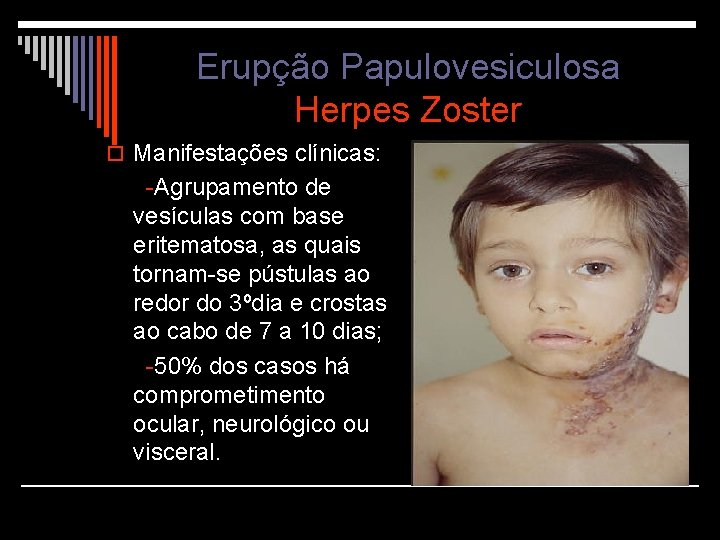 Erupção Papulovesiculosa Herpes Zoster o Manifestações clínicas: -Agrupamento de vesículas com base eritematosa, as