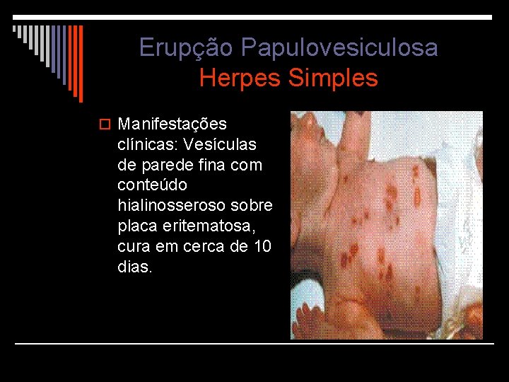 Erupção Papulovesiculosa Herpes Simples o Manifestações clínicas: Vesículas de parede fina com conteúdo hialinosseroso