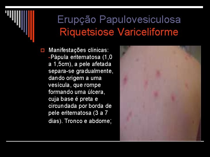 Erupção Papulovesiculosa Riquetsiose Variceliforme o Manifestações clínicas: -Pápula eritematosa (1, 0 a 1, 5