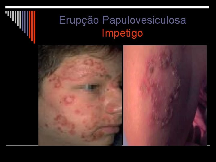 Erupção Papulovesiculosa Impetigo 