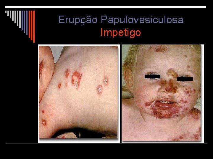 Erupção Papulovesiculosa Impetigo 