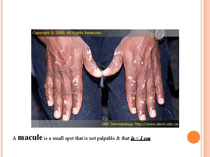 A macule is a small spot that is not palpable & that is <