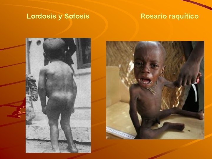 Lordosis y Sofosis Rosario raquítico 