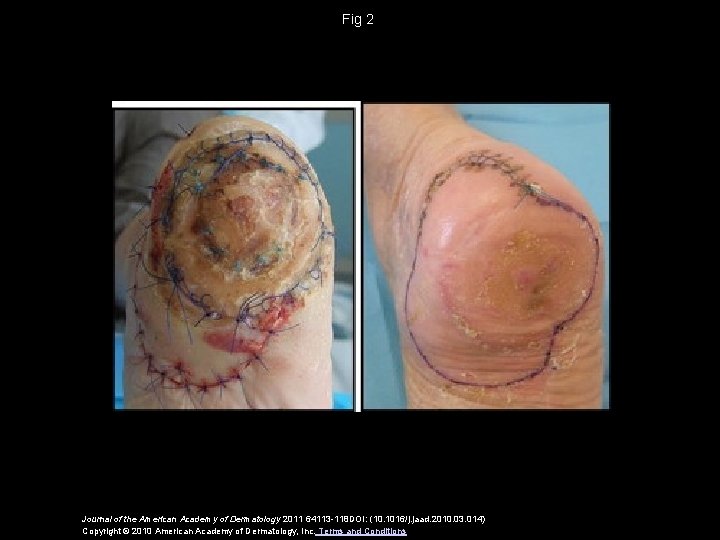 Fig 2 Journal of the American Academy of Dermatology 2011 64113 -118 DOI: (10.