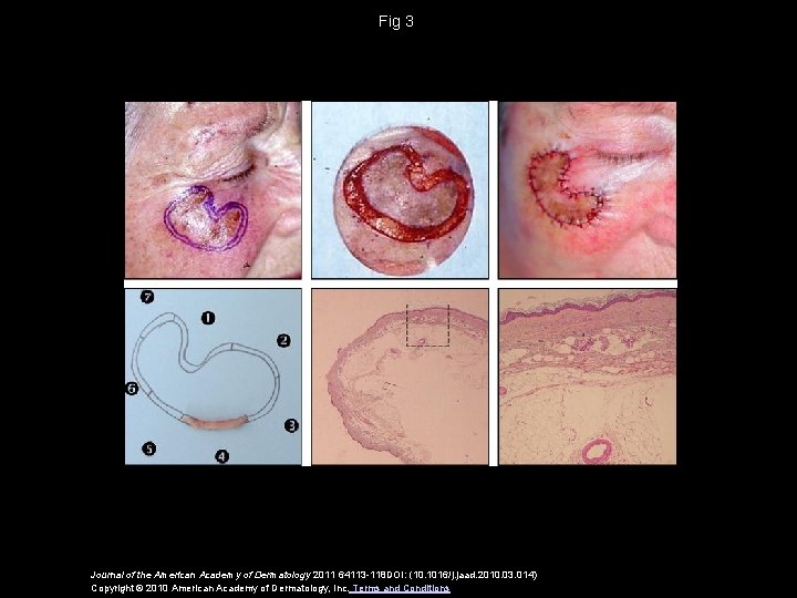 Fig 3 Journal of the American Academy of Dermatology 2011 64113 -118 DOI: (10.