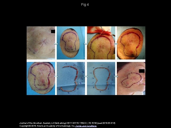 Fig 4 Journal of the American Academy of Dermatology 2011 64113 -118 DOI: (10.