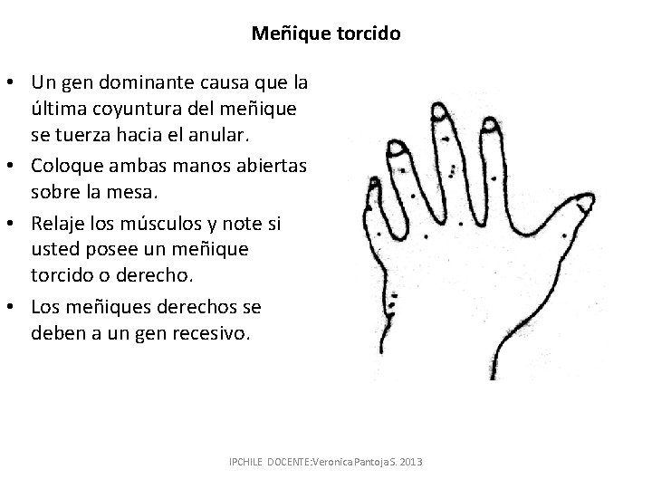 Meñique torcido • Un gen dominante causa que la última coyuntura del meñique se