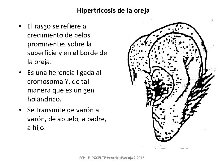 Hipertricosis de la oreja • El rasgo se refiere al crecimiento de pelos prominentes