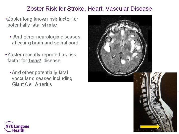 Zoster Risk for Stroke, Heart, Vascular Disease • Zoster long known risk factor for