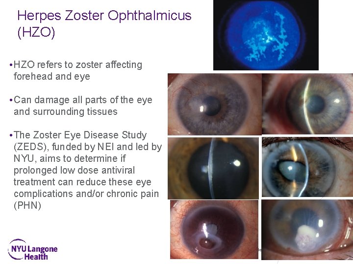 Herpes Zoster Ophthalmicus (HZO) • HZO refers to zoster affecting forehead and eye •