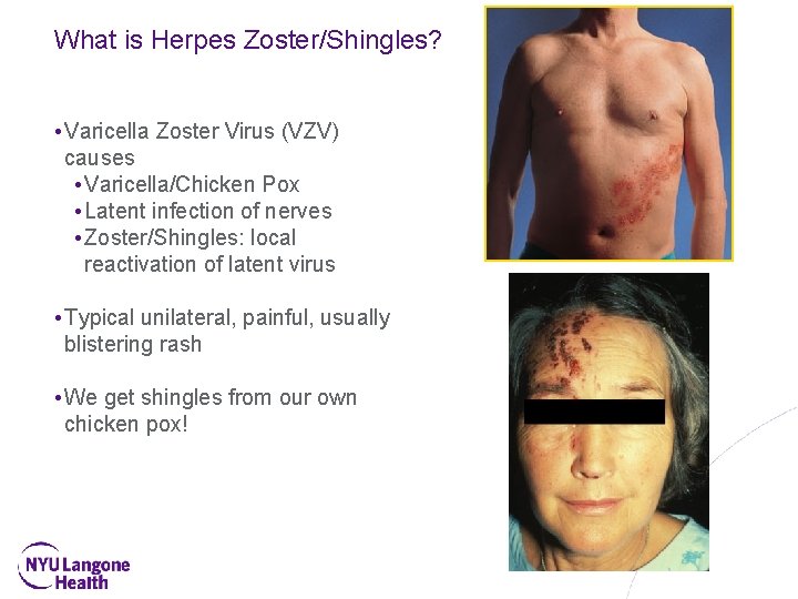 What is Herpes Zoster/Shingles? • Varicella Zoster Virus (VZV) causes • Varicella/Chicken Pox •