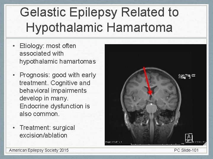 Gelastic Epilepsy Related to Hypothalamic Hamartoma • Etiology: most often associated with hypothalamic hamartomas