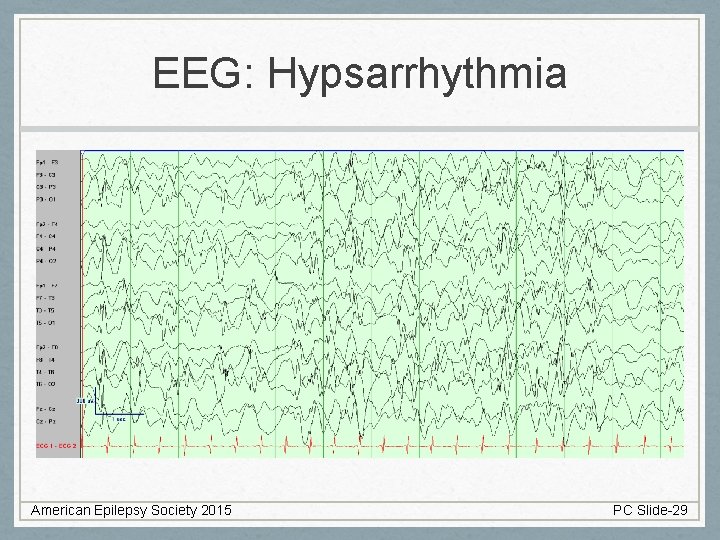 EEG: Hypsarrhythmia American Epilepsy Society 2015 PC Slide-29 