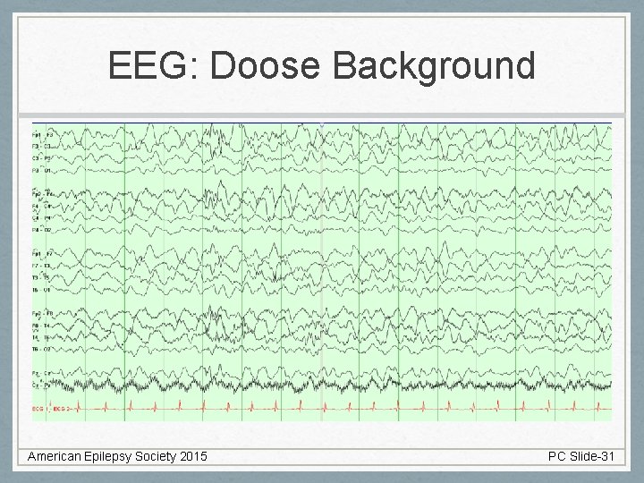 EEG: Doose Background American Epilepsy Society 2015 PC Slide-31 