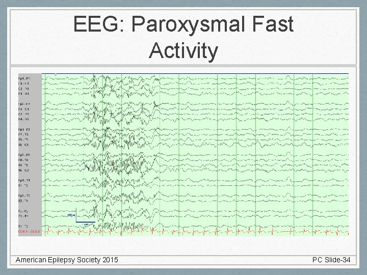 EEG: Paroxysmal Fast Activity American Epilepsy Society 2015 PC Slide-34 