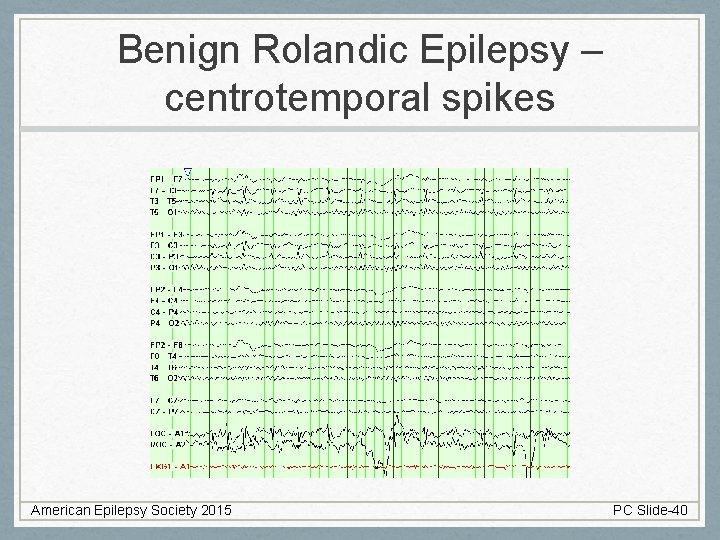 Benign Rolandic Epilepsy – centrotemporal spikes American Epilepsy Society 2015 PC Slide-40 