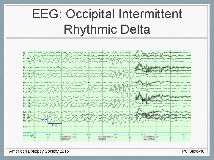 EEG: Occipital Intermittent Rhythmic Delta American Epilepsy Society 2015 PC Slide-46 