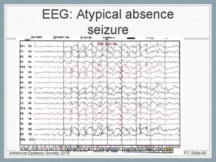 EEG: Atypical absence seizure American Epilepsy Society 2015 PC Slide-49 