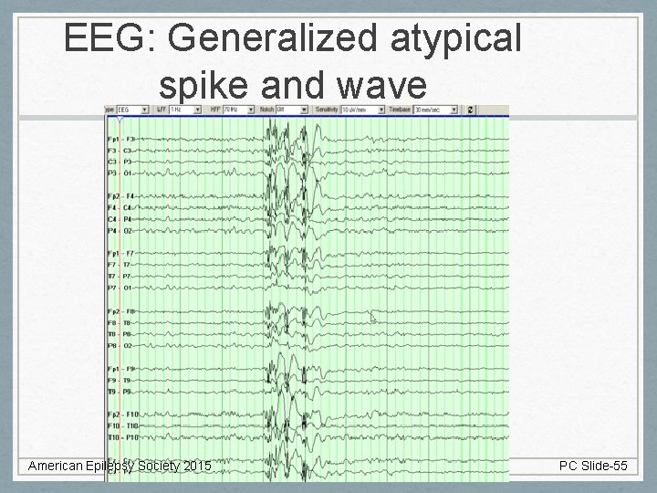 EEG: Generalized atypical spike and wave American Epilepsy Society 2015 PC Slide-55 