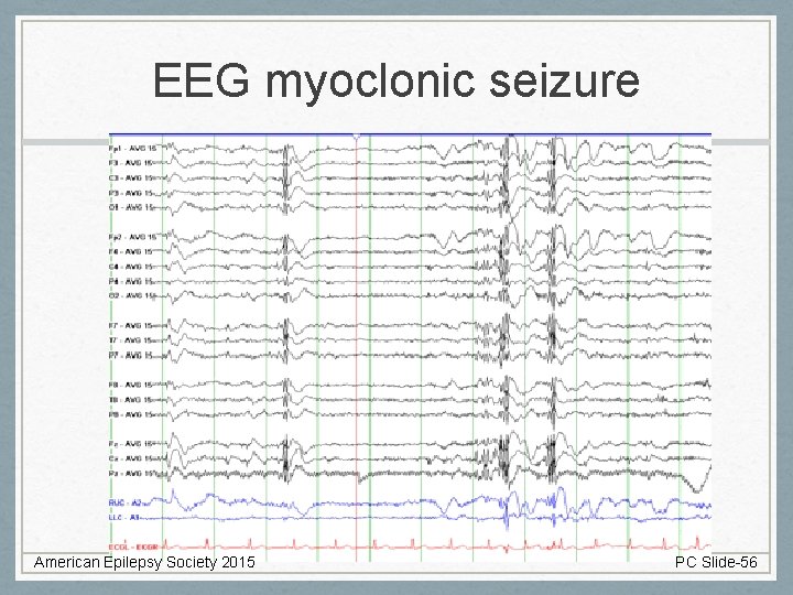 EEG myoclonic seizure American Epilepsy Society 2015 PC Slide-56 