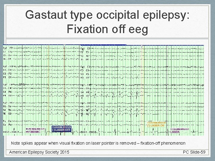 Gastaut type occipital epilepsy: Fixation off eeg Note spikes appear when visual fixation on
