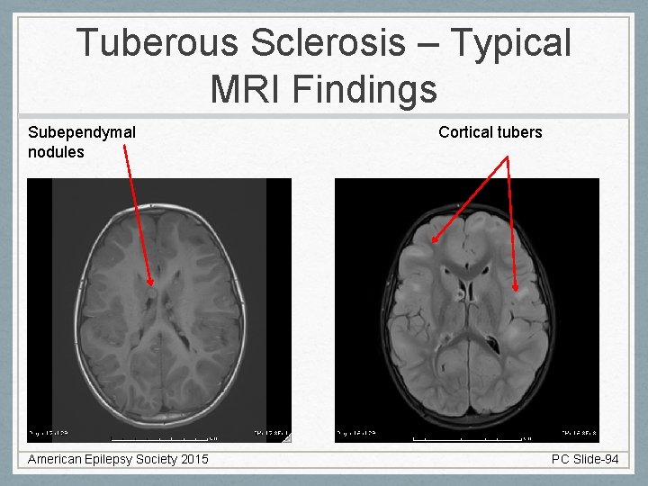 Tuberous Sclerosis – Typical MRI Findings Subependymal nodules American Epilepsy Society 2015 Cortical tubers