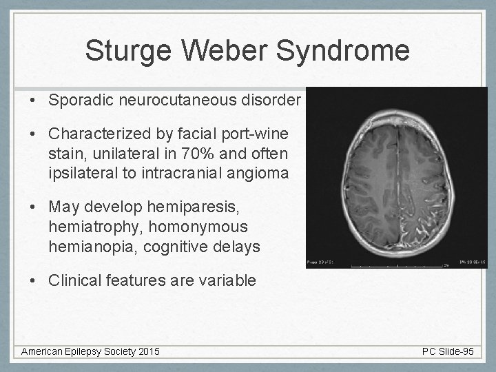 Sturge Weber Syndrome • Sporadic neurocutaneous disorder • Characterized by facial port-wine stain, unilateral