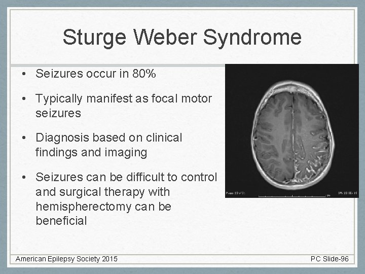 Sturge Weber Syndrome • Seizures occur in 80% • Typically manifest as focal motor