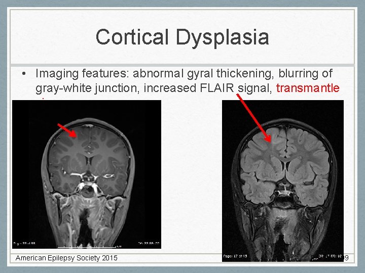 Cortical Dysplasia • Imaging features: abnormal gyral thickening, blurring of gray-white junction, increased FLAIR