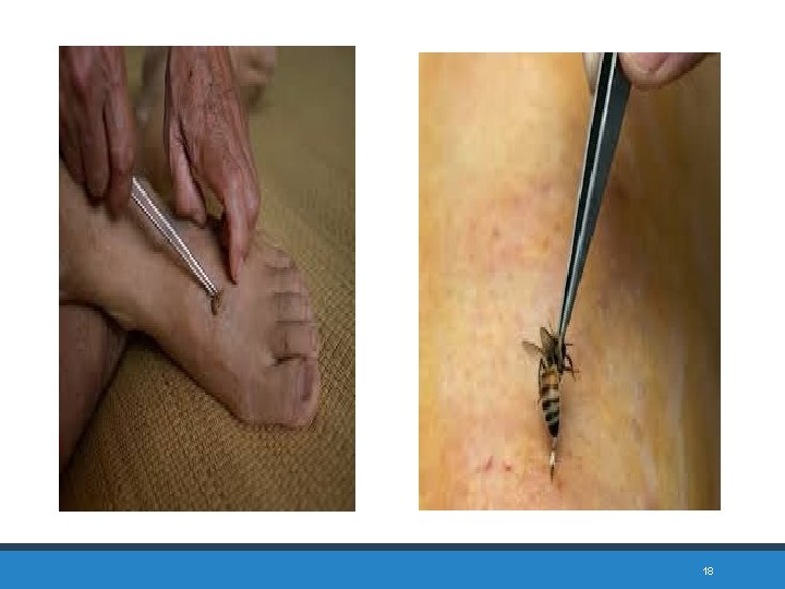 Bee venom acupuncture in different neurological illness and