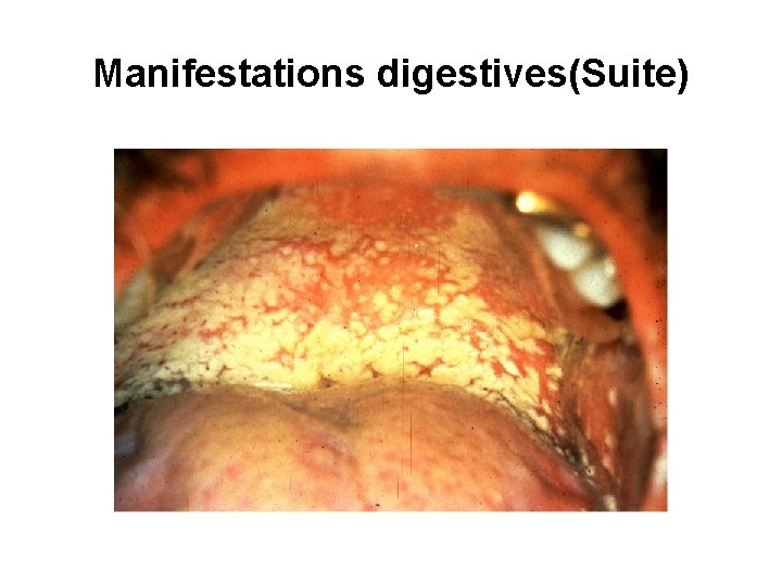 Manifestations digestives(Suite) 