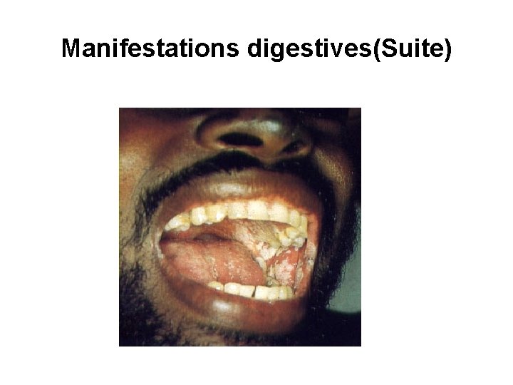 Manifestations digestives(Suite) 