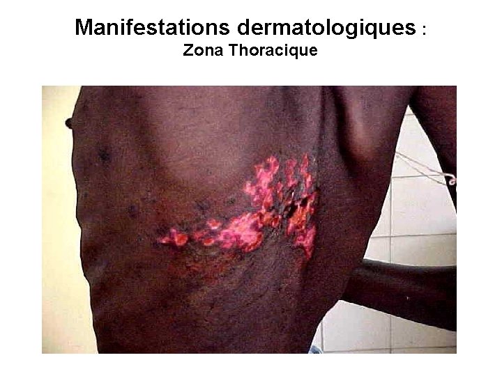 Manifestations dermatologiques : Zona Thoracique 