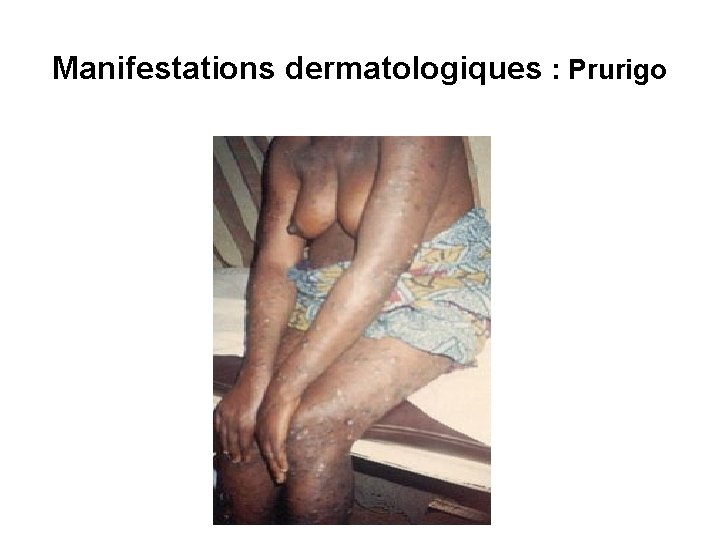 Manifestations dermatologiques : Prurigo 